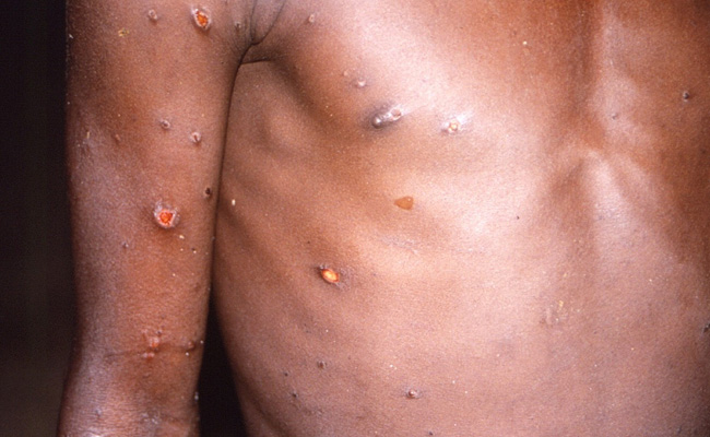Monkeypox Spreading Through "Possible Sexual Transmission": 5 Points