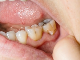 Teeth: 6 Habits That Could Lead To Tooth Decay & 6 Habits To Prevent It Teeth: 6 Habits That Could Lead To Tooth Decay & 6 Habits To Prevent It