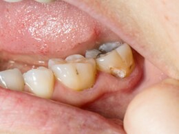 दांतों में दर्द और कीड़े का घरेलू इलाज है यहां, जानें कीड़ा लगे, पीले, खोखले दांत कैसे होंगे ठीक दांतों में दर्द और कीड़े का घरेलू इलाज है यहां, जानें कीड़ा लगे, पीले, खोखले दांत कैसे होंगे ठीक