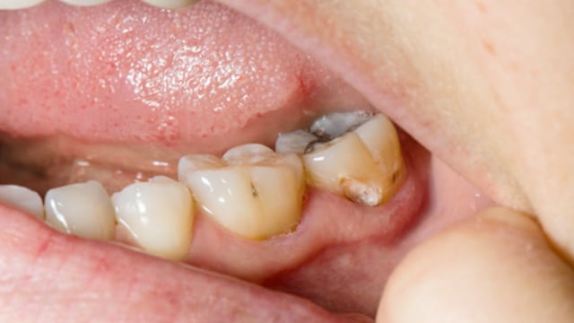 Sugary and acidic foods can contribute to tooth decay