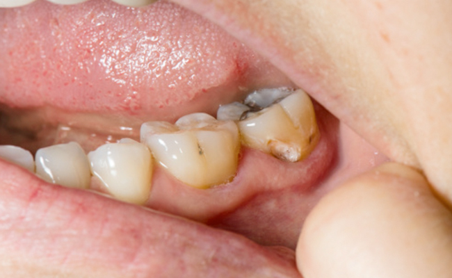 Sugary and acidic foods can contribute to tooth decay