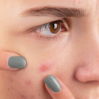 https://c.ndtvimg.com/2022-05/ujqdtvfg_post-workout-acne_295x200_23_May_22.jpg