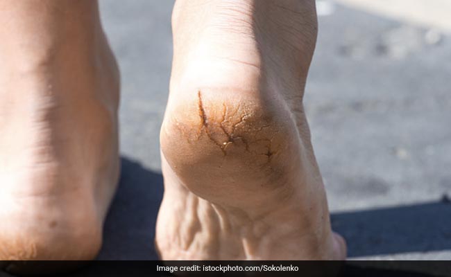 5 Home Remedies For Cracked Heels To Get Your Feet Monsoon Ready