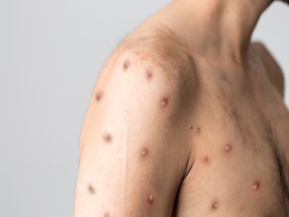 Monkeypox New Case: विदेश यात्रा भी नहीं की, फिर भी हो गए पॉजिटिव, जानें मंकीपॉक्स के लक्षण, कैसे फैलता है और इलाज Monkeypox New Case: विदेश यात्रा भी नहीं की, फिर भी हो गए पॉजिटिव, जानें मंकीपॉक्स के लक्षण, कैसे फैलता है और इलाज