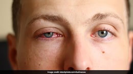 Eye Health: Constantly Rubbing Your Eye? This Could Be Why