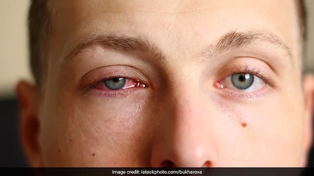 Vitamin D deficiency can weaken immunity which can increase risk of conjunctivitis