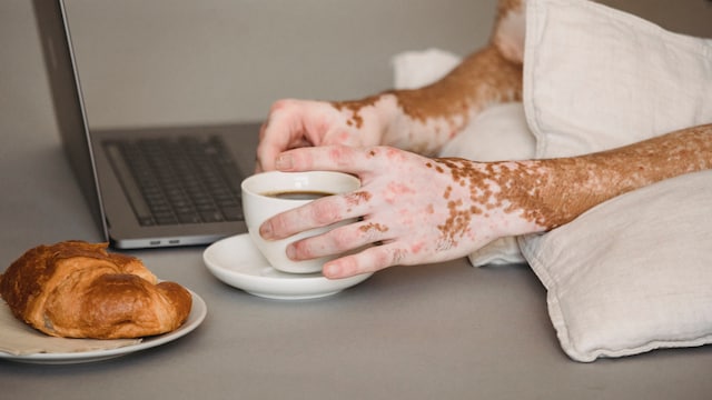 World Vitiligo Day 2022: Vitiligo causes patchiness in the skin due to lack of melanin