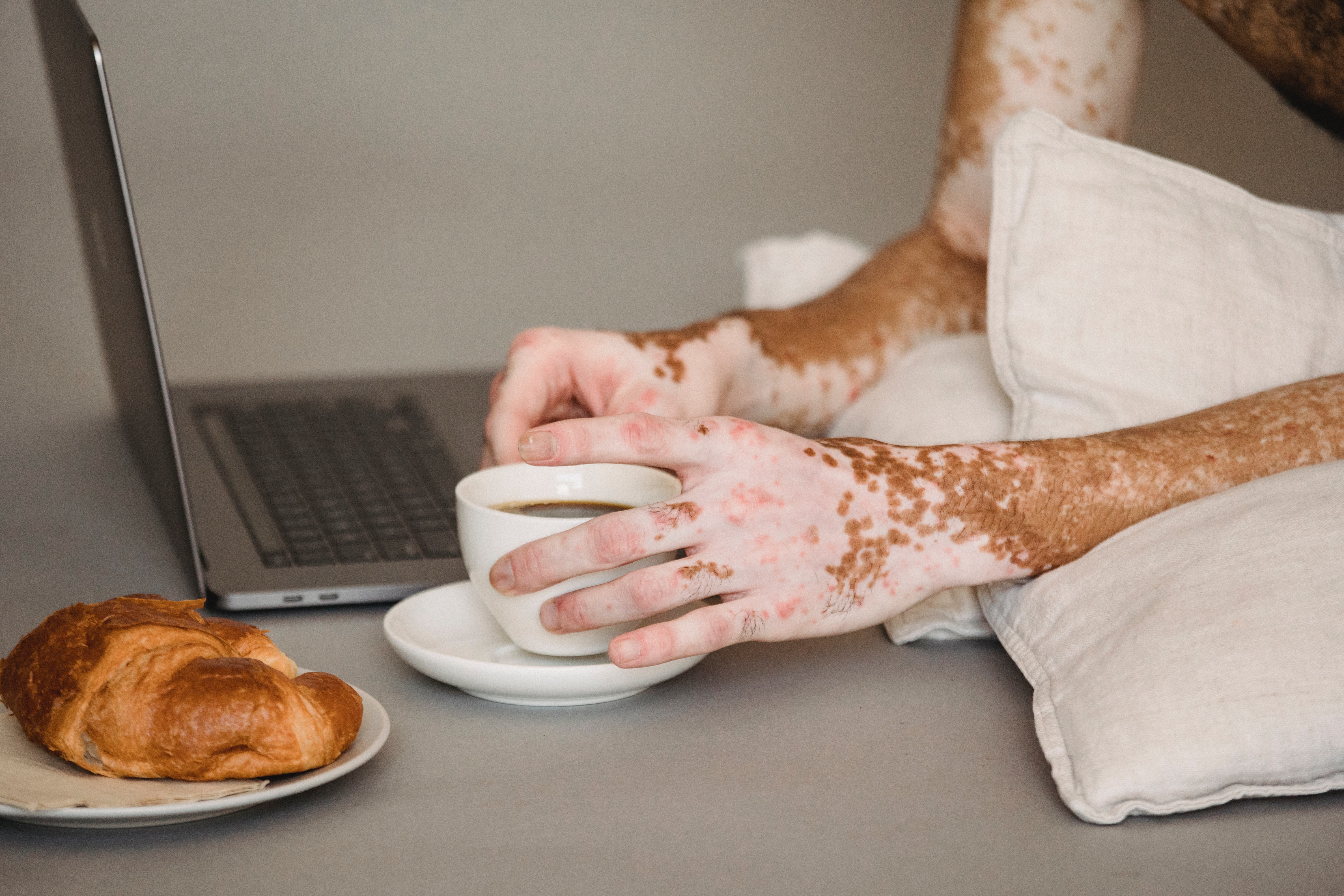 World Vitiligo Day 2022: Vitiligo causes patchiness in the skin due to lack of melanin