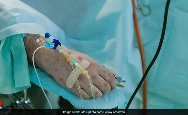 Monkeypox FAQs: Here's All You Need To Know