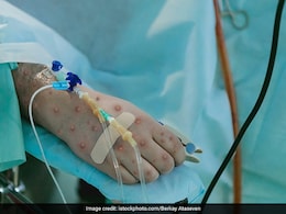 Is Monkeypox Global Health Emergency? WHO Experts Split On Decision: Report