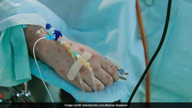 Monkeypox: It may cause symptoms like that of smallpox, usually milder