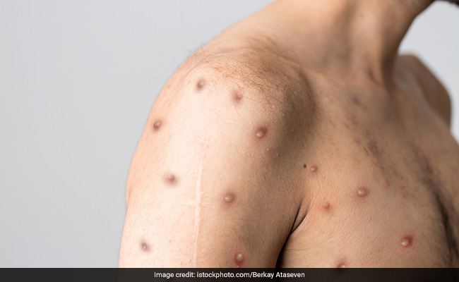 Monkeypox: What Are The Updates? Why Is It A Global Concern?