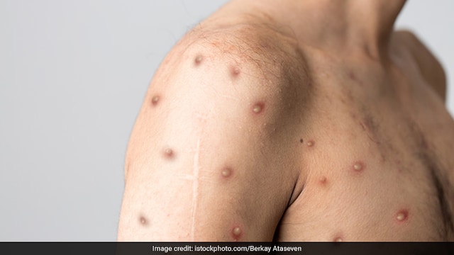 Monkeypox outbreak: monkeypox may cause blisters that can infect others upon contact