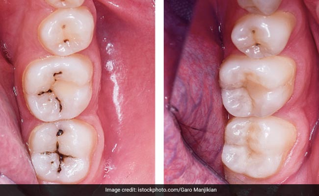 Cavity Home Remedies: दांतों में लंबे समय से लगे काले कीड़ों से हैं परेशान तो ये 3 घरेलू उपाय आएंगे काम