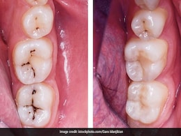 Cavity Home Remedies: दांतों में लंबे समय से लगे काले कीड़ों से हैं परेशान तो ये 3 घरेलू उपाय आएंगे काम Cavity Home Remedies: दांतों में लंबे समय से लगे काले कीड़ों से हैं परेशान तो ये 3 घरेलू उपाय आएंगे काम