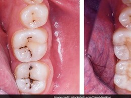 Cavity Home Remedies: दांतों में लंबे समय से लगे कीड़ों से राहत दिलाएंगे ये 4 घरेलू उपाय Cavity Home Remedies: दांतों में लंबे समय से लगे कीड़ों से राहत दिलाएंगे ये 4 घरेलू उपाय