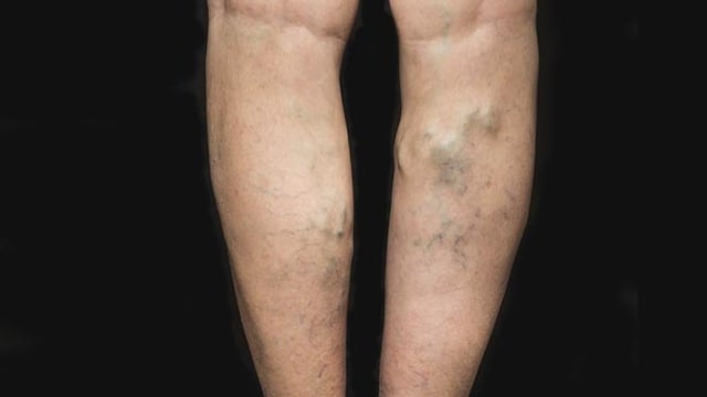 Varicose veins are swollen and twisted veins that are visible just below the surface of the skin