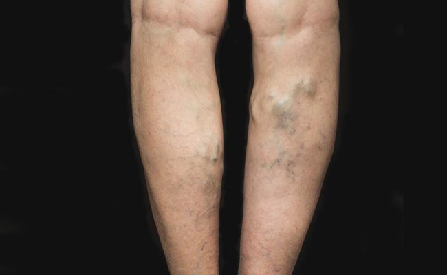 Varicose veins are swollen and twisted veins that are visible just below the surface of the skin