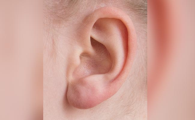 "Historic Moment": Doctors Successfully Transplant 3D-Printed Ear Made Of Living Cells