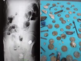 इस शख्स के पेट में 233 सिक्के, बैटरी, चुम्बक, कील और कांच के टुकड़े थे, अभी तक ये ज़िंदा है इस शख्स के पेट में 233 सिक्के, बैटरी, चुम्बक, कील और कांच के टुकड़े थे, अभी तक ये ज़िंदा है