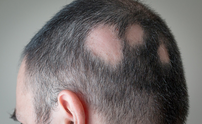 Patchy Hair Loss (Alopecia areata): क्या है बाल खोरा या एलोपेसिया, क्‍यों लग जाता है बालों में कीड़ा, इसे कैसे ठीक करें?