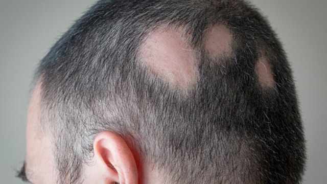 Alopecia areata is the kind of alopecia which causes hair loss in patches on the scalp