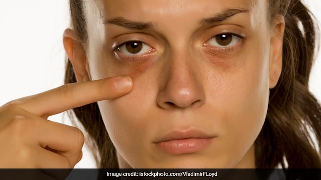 Inculcating healthy habits to your routine can help reduce dark circles