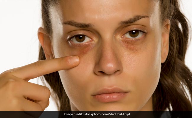 Inculcating healthy habits to your routine can help reduce dark circles