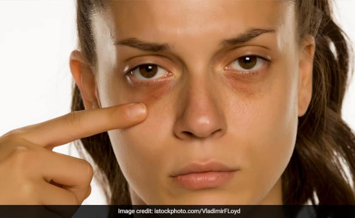 Dark Circles आंखों के डार्क सर्कल से हो गए है परेशान? तो अपनाएं ये