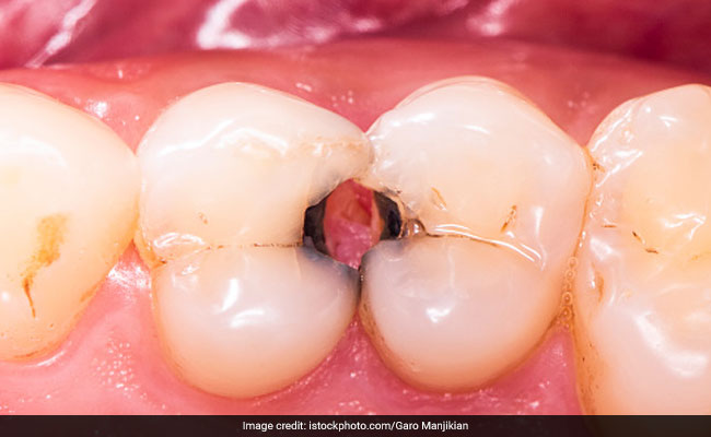 दांतों में दिखने वाले काले कीड़ों से छुटकारा दिलाता है घर पर बना यह हर्बल पाउडर, बच्चों और बड़ों सभी की Teeth Cavity होगी दूर
