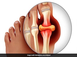 High Uric Acid Level: 13 वजहें जिनसे बढ़ जाता है यूरिक एसिड और वो 7 चीजें जो बढ़े हुए यूरिक एसिड में कभी नहीं खानी चाहिए | परहेज हो सकते हैं यूरिक एसिड की रामबाण दवा High Uric Acid Level: 13 वजहें जिनसे बढ़ जाता है यूरिक एसिड और वो 7 चीजें जो बढ़े हुए यूरिक एसिड में कभी नहीं खानी चाहिए | परहेज हो सकते हैं यूरिक एसिड की रामबाण दवा