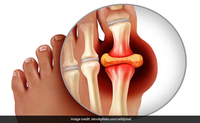 Uric Acid को कम करने में इन आयुर्वेदिक नुस्खों से मिलेगी मदद, खून में जमा गंदा यूरिक एसिड निकलेगा बाहर