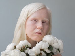 International Albinism Awareness Day: जानिए क्या है ऐल्बिनिज़म, कैसे होती है ये बीमारी, इसके लक्षण, कारण, बचाव और इलाज International Albinism Awareness Day: जानिए क्या है ऐल्बिनिज़म, कैसे होती है ये बीमारी, इसके लक्षण, कारण, बचाव और इलाज