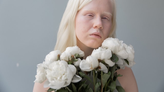 Albinism is the absence of melanin is the body which causes lack of pigment to the skin, hair and eyes