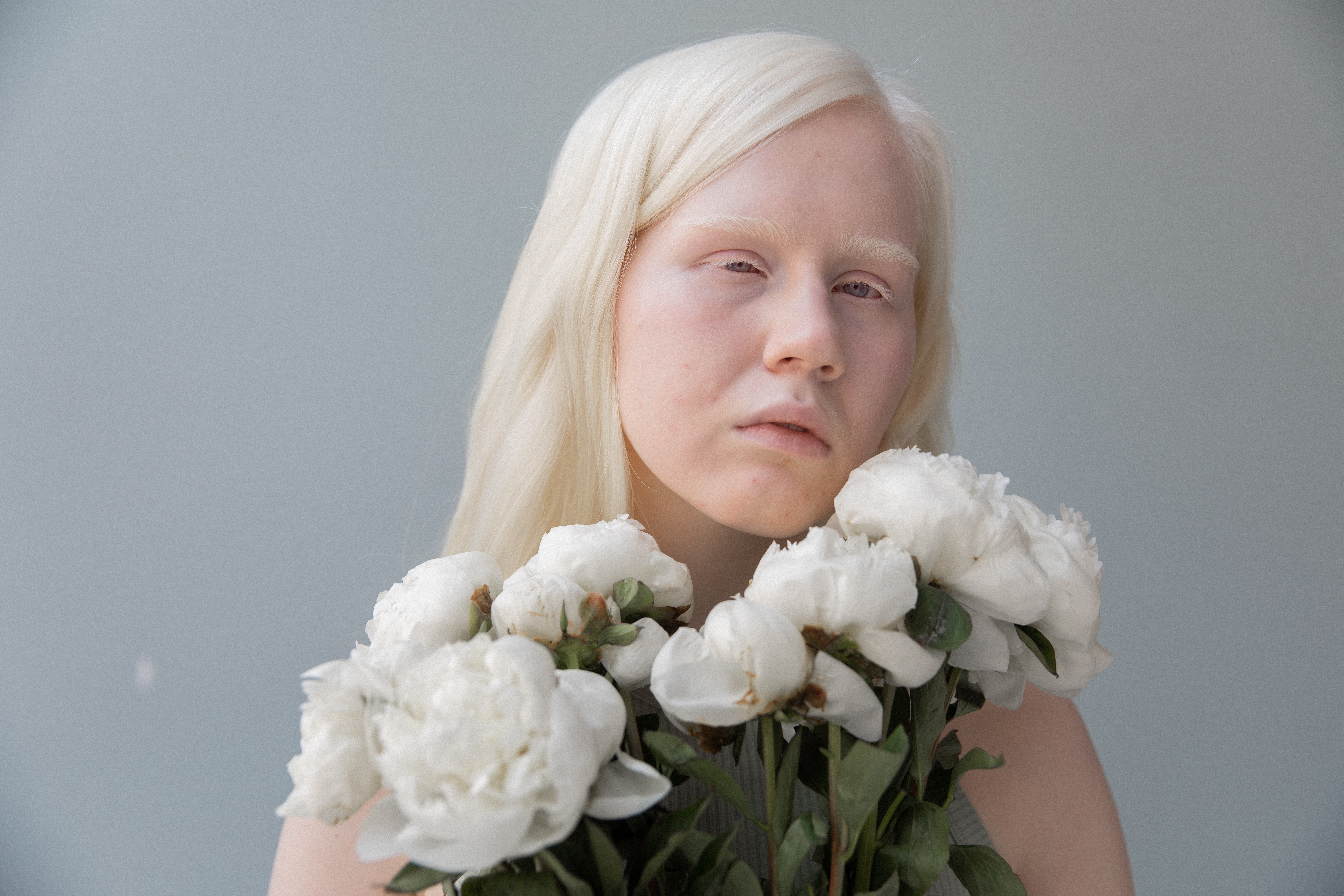 Albinism is the absence of melanin is the body which causes lack of pigment to the skin, hair and eyes