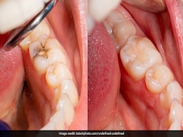 Worst Foods For Teeth: दांतों को खराब कर देती हैं ये 5 चीजें, ज्यादा मात्रा में न करें सेवन Worst Foods For Teeth: दांतों को खराब कर देती हैं ये 5 चीजें, ज्यादा मात्रा में न करें सेवन