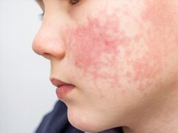 चेहरे पर दिखने वाले ये 4 लक्षण हो सकते हैं गंभीर बीमारियों के संकेत, आज ही दें ध्यान, नजरअंदाज करना पड़ सकता है भारी चेहरे पर दिखने वाले ये 4 लक्षण हो सकते हैं गंभीर बीमारियों के संकेत, आज ही दें ध्यान, नजरअंदाज करना पड़ सकता है भारी