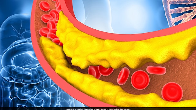 Having high bad cholesterol levels can affect blood flow due to access plaque buildup in the arteries