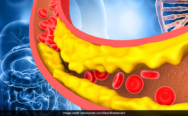 Having high bad cholesterol levels can affect blood flow due to access plaque buildup in the arteries