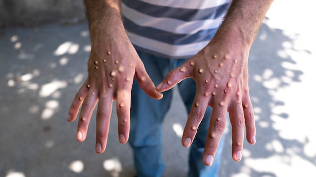 Monkeypox A.2 strain may also cause lymph nodes