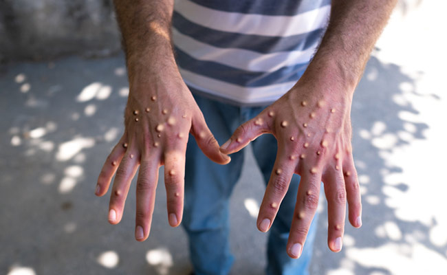 Monkeypox A.2 strain may also cause lymph nodes