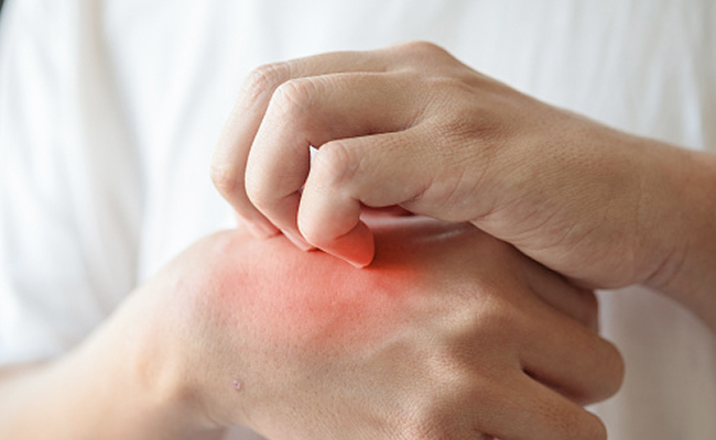 Tips To Get Rid Of The Summer Itch