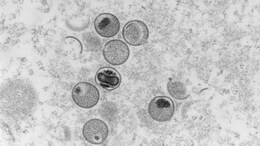 Monkeypox Declared Global Health Emergency By WHO Amid Rising Cases