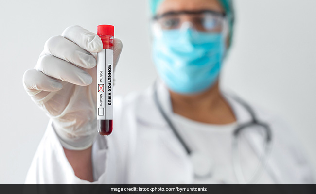 Monkeypox Virus Isolated By Indian Scientists, May Pave Way For Vaccines