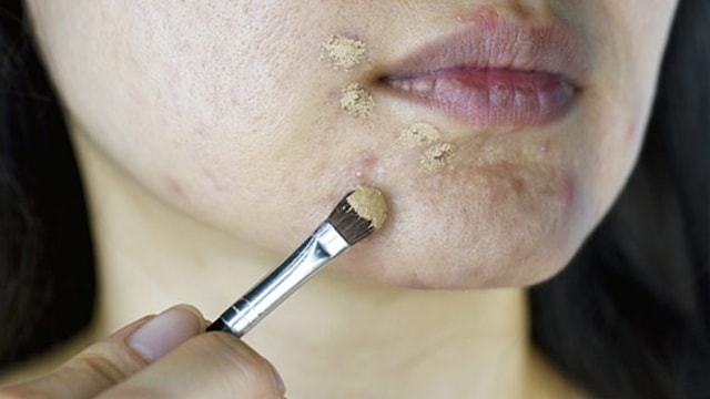 Residue of sunscreen, make up and other products might worsen acne