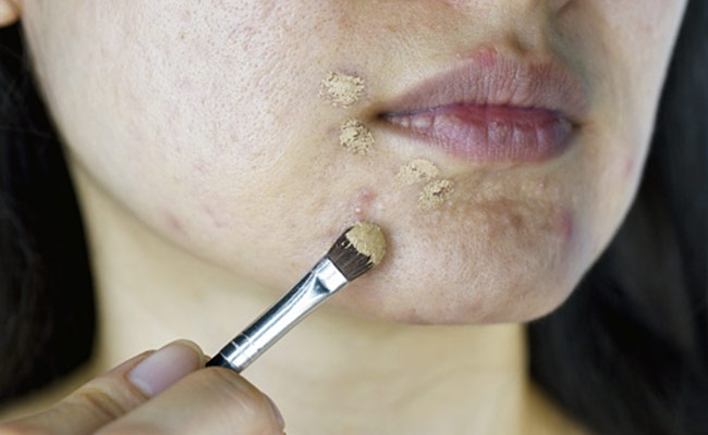 Residue of sunscreen, make up and other products might worsen acne