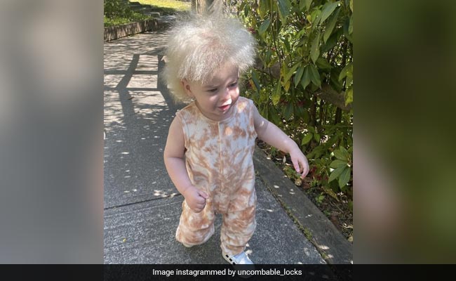 Rare Condition Leaves Baby Looking Like Einstein As Her Hair Can't Be Combed