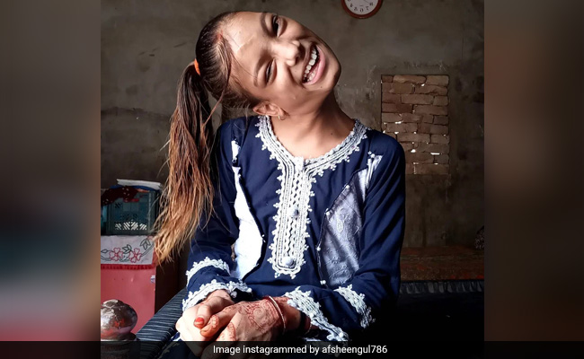 Girl With Neck Bent At 90 Degrees Treated Successfully By Doc, For Free