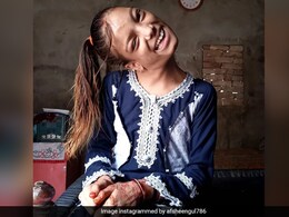 डॉक्टर ने 90 डिग्री झुकी गर्दन वाली लड़की का मुफ्त में किया सफल इलाज डॉक्टर ने 90 डिग्री झुकी गर्दन वाली लड़की का मुफ्त में किया सफल इलाज