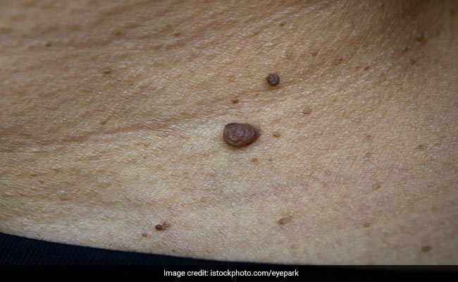 शरीर पर निकल आए मस्सों को कम करने में असर दिखा सकती हैं ये 3 चीजें, जानिए कैसे करें इस्तेमाल